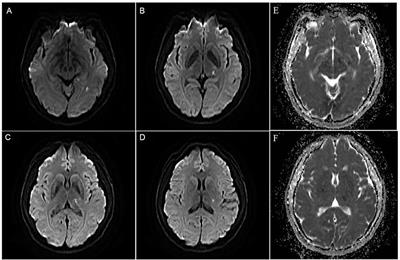 Case Report: Advantages of High-Resolution MRI in Evaluating the Efficacy of Drug Therapy for Intracranial Atherosclerotic Plaques